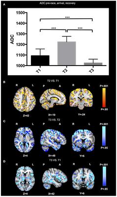 Extreme Mountain <mark class="highlighted">Ultra-Marathon</mark> Leads to Acute but Transient Increase in Cerebral Water Diffusivity and Plasma Biomarkers Levels Changes